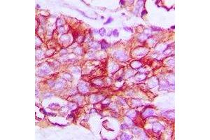 Immunohistochemical analysis of IFNGR1 staining in human breast cancer formalin fixed paraffin embedded tissue section. (IFNGR1 anticorps  (C-Term))