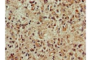 Immunohistochemistry of paraffin-embedded human glioma using ABIN7149696 at dilution of 1:100 (DCK anticorps  (AA 1-79))