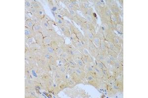 Immunohistochemistry of paraffin-embedded human liver cancer using CEACAM7 antibody (ABIN5974489) at dilution of 1/100 (40x lens). (CEACAM7 anticorps)