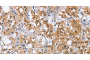 Immunohistochemistry of paraffin-embedded Human thyroid cancer tissue using MLH1 Polyclonal Antibody at dilution 1:65 (MLH1 anticorps)
