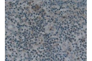 Detection of NPNT in Human Skin cancer Tissue using Polyclonal Antibody to Nephronectin (NPNT)