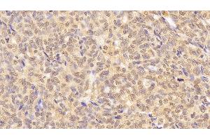 Detection of LMNB1 in Human Ovarian cancer Tissue using Anti-Lamin B1 (LMNB1) Monoclonal Antibody