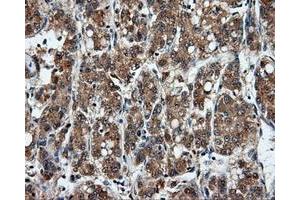 Immunohistochemical staining of paraffin-embedded Carcinoma of liver tissue using anti-MSMB mouse monoclonal antibody.