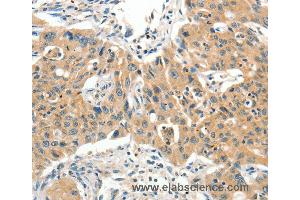Immunohistochemistry of Human lung cancer using SLC11A2 Polyclonal Antibody at dilution of 1:65 (SLC11A2 anticorps)