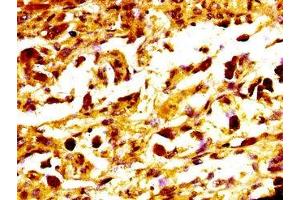 IHC image of ABIN7159233 diluted at 1:400 and staining in paraffin-embedded human melanoma performed on a Leica BondTM system.