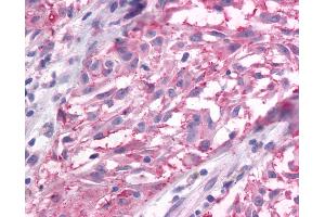 Anti-GRM3 / MGLUR3 antibody IHC of human Skin, Melanoma.