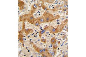 Formalin-fixed and paraffin-embedded human hepatocarcinoma reacted with GCG Antibody (N-term), which was peroxidase-conjugated to the secondary antibody, followed by DAB staining.