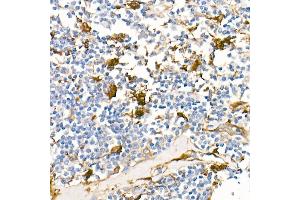 Immunohistochemistry of paraffin-embedded Human Hodgkin lymphoma using Fascin/FSCN1 antibody (ABIN7267142) at dilution of 1:100 (40x lens). (Fascin anticorps)