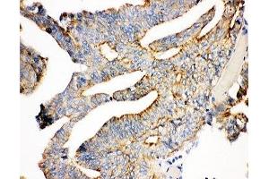 IHC-P: Plakoglobin antibody testing of human intestine cancer tissue