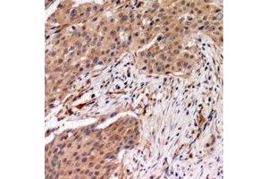 Immunohistochemical analysis of MYPT1 (pT696) staining in human breast cancer formalin fixed paraffin embedded tissue section. (PPP1R12A anticorps  (pSer696))
