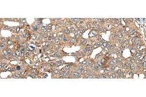 Immunohistochemistry of paraffin-embedded Human liver cancer tissue using BRD9 Polyclonal Antibody at dilution of 1:80(x200)