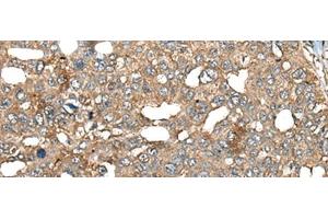 Immunohistochemistry of paraffin-embedded Human liver cancer tissue using BRD9 Polyclonal Antibody at dilution of 1:80(x200) (BRD9 anticorps)