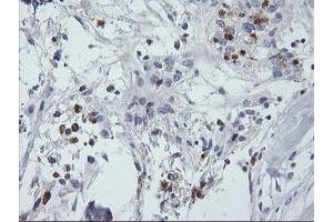 Immunohistochemical staining of paraffin-embedded Adenocarcinoma of Human breast tissue using anti-SDS mouse monoclonal antibody. (serine Dehydratase anticorps)
