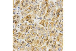 Immunohistochemistry of paraffin-embedded human liver cancer using TPM2 antibody (ABIN5971583) at dilution of 1/200 (40x lens). (TPM2 anticorps)