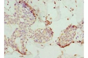 Immunohistochemistry of paraffin-embedded human breast cancer using ABIN7173557 at dilution of 1:100 (Tropomodulin 4 anticorps  (AA 1-345))