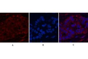 Immunofluorescence analysis of human liver cancer tissue. (Cytochrome C anticorps)