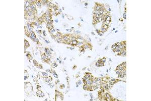 Immunohistochemistry of paraffin-embedded human gastric cancer using ALKBH8 antibody (ABIN5974297) at dilution of 1/100 (40x lens).