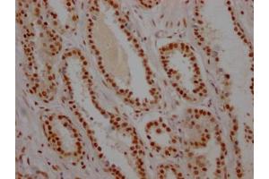 IHC image of ABIN7127535 diluted at 1:100 and staining in paraffin-embedded human prostate cancer performed on a Leica BondTM system. (Recombinant USP7 anticorps)