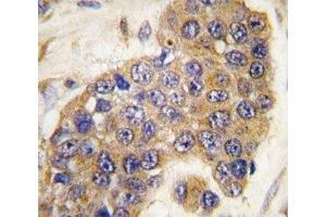IHC analysis of FFPE human breast carcinoma tissue stained with Puma antibody