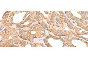Immunohistochemistry of paraffin-embedded Human thyroid cancer tissue using DEF8 Polyclonal Antibody at dilution of 1:25(x200) (DEF8 anticorps)