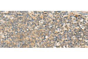 Immunohistochemistry of paraffin-embedded Human colorectal cancer tissue using PAFAH1B3 Polyclonal Antibody at dilution of 1:70(x200)