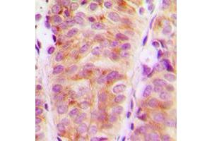 Immunohistochemical analysis of ARHGEF10 staining in human breast cancer formalin fixed paraffin embedded tissue section. (ARHGEF10 anticorps  (Center))