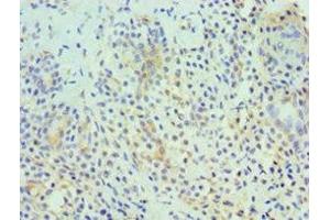 Immunohistochemistry of paraffin-embedded human breast cancer using ABIN7155322 at dilution of 1:100 (HDAC6 anticorps  (AA 160-470))