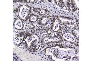 IHC analysis of APE1 using anti-APE1 antibody .