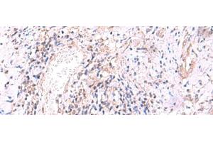Immunohistochemistry of paraffin-embedded Human cervical cancer tissue using MRPS24 Polyclonal Antibody at dilution of 1:90(x200) (MRPS24 anticorps)