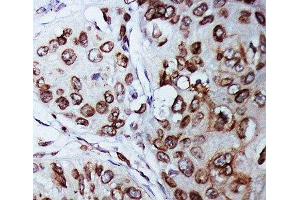 IHC-P: Lamin B1 antibody testing of human breast cancer tissue (Lamin B1 anticorps  (AA 570-586))