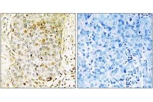 Immunohistochemistry analysis of paraffin-embedded human breast carcinoma tissue, using MLK3 (Ab-674) Antibody.