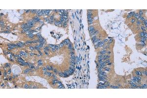 Immunohistochemistry of paraffin-embedded Human colon cancer using HYAL3 Polyclonal Antibody at dilution of 1:40 (HYAL3 anticorps)