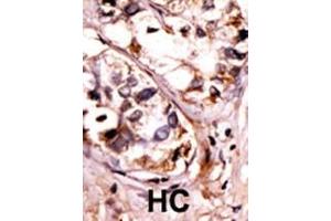 Formalin-fixed and paraffin-embedded human cancer tissue reacted with the primary antibody, which was peroxidase-conjugated to the secondary antibody, followed by AEC staining. (SYK anticorps  (pTyr525, pTyr526))