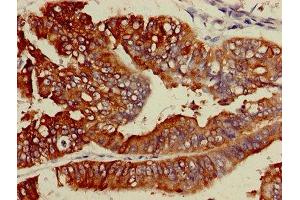 IHC image of ABIN7158511 diluted at 1:600 and staining in paraffin-embedded human endometrial cancer performed on a Leica BondTM system.