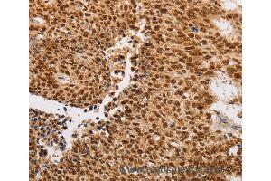 Immunohistochemistry of Human lung cancer using THOC7 Polyclonal Antibody at dilution of 1:30 (THOC7 anticorps)