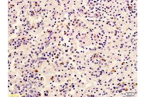 Formalin-fixed and paraffin embedded human cervical carcinoma labeled with Anti-HER2/NEU/ErbB2 Polyclonal Antibody, Unconjugated  at 1:400 followed by conjugation to the secondary antibody and DAB staining