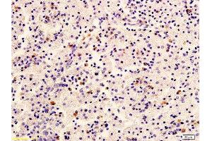 Formalin-fixed and paraffin embedded human cervical carcinoma labeled with Anti-HER2/NEU/ErbB2 Polyclonal Antibody, Unconjugated  at 1:400 followed by conjugation to the secondary antibody and DAB staining (ErbB2/Her2 anticorps  (AA 1210-1255))