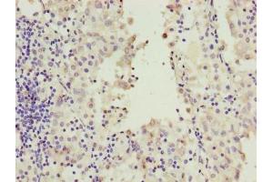 Immunohistochemistry of paraffin-embedded human lung cancer using ABIN7167244 at dilution of 1:100 (RAB2A anticorps  (AA 1-234))