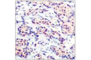 Immunohistochemical analysis of paraffin-embedded human breast carcinoma tissue using JUND polyclonal antibody  .