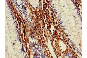 Immunohistochemistry of paraffin-embedded human colon cancer using ABIN7148281 at dilution of 1:100 (MMP13 anticorps  (AA 104-471))