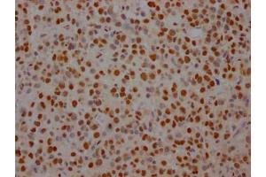 IHC image of ABIN7127805 diluted at 1:100 and staining in paraffin-embedded human glioma cancer performed on a Leica BondTM system.