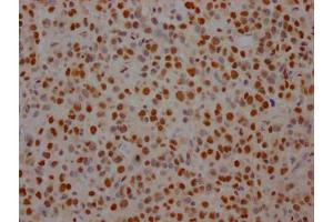 IHC image of ABIN7127805 diluted at 1:100 and staining in paraffin-embedded human glioma cancer performed on a Leica BondTM system. (Recombinant SF3B1 anticorps)