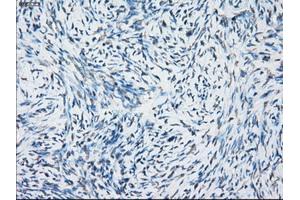 Immunohistochemical staining of paraffin-embedded Adenocarcinoma of breast tissue using anti-NAT8 mouse monoclonal antibody. (NAT8 anticorps)