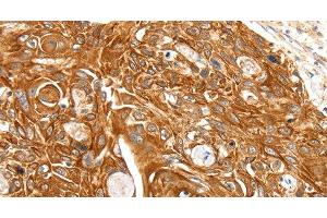 Immunohistochemistry of paraffin-embedded Human esophagus cancer using SFTPA1 Polyclonal Antibody at dilution of 1:30 (Surfactant Protein A1 anticorps)