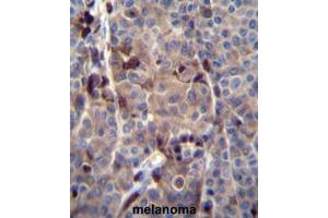 PRAMEF8 Antibody (C-term) immunohistochemistry analysis in formalin fixed and paraffin embedded human melanoma tissue followed by peroxidase conjugation of the secondary antibody and DAB staining. (PRAMEF8 anticorps  (C-Term))