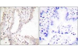 Immunohistochemistry analysis of paraffin-embedded human lung carcinoma tissue, using Prostate Apoptosis Response protein-4 Antibody. (PAWR anticorps  (AA 291-340))