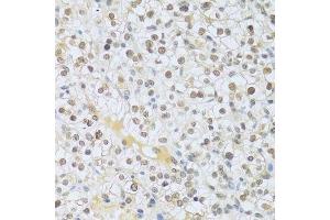 Immunohistochemistry of paraffin-embedded human kidney cancer using MAPK3 Antibody.