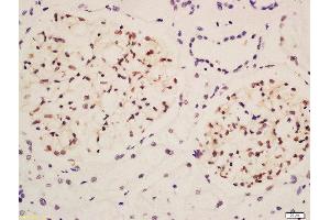 Formalin-fixed and paraffin embedded labeled with Rabbit Anti-Podocin Polyclonal Antibody, Unconjugated  at 1:200 followed by conjugation to the secondary antibody and DAB staining