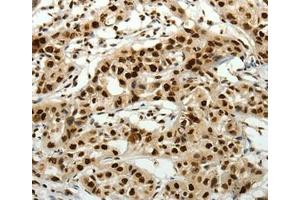 Immunohistochemical analysis of paraffin-embedded Human lung cancer tissue using at dilution 1/40. (SCN11A anticorps  (Internal Region))
