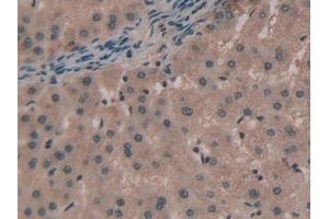 Detection of TNPO1 in Human Liver cancer Tissue using Polyclonal Antibody to Transportin 1 (TNPO1) (Transportin 1 anticorps  (AA 626-836))